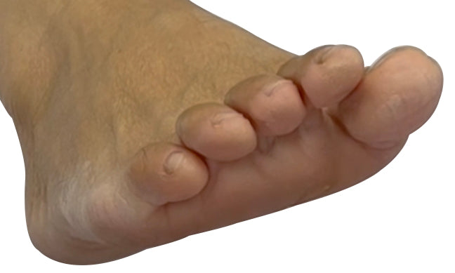 Silicone Toe Aligners أدوات محاذاة أصابع القدم المصنوعة من السيليكون