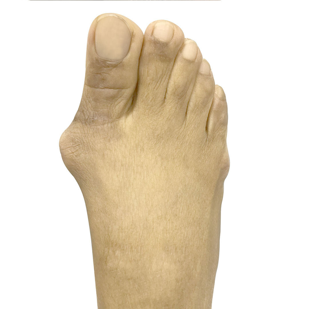 foot with bunion